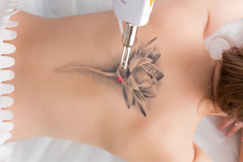 Tattooentfernen